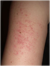 keratosis